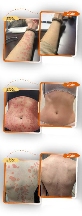 ✅ Pureluxo® Fekete Rizses Bőrregeneráló Krém 👨‍⚕️ (Szemölcsök, bőrkinövések, foltok és hiperpigmentáció kezelésére)✅✅