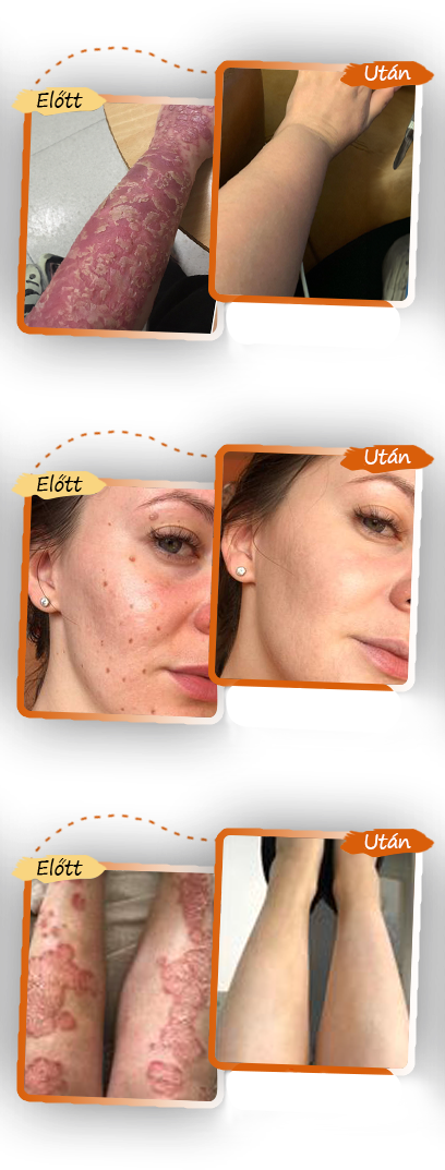 ✅ Pureluxo® Fekete Rizses Bőrregeneráló Krém 👨‍⚕️ (Szemölcsök, bőrkinövések, foltok és hiperpigmentáció kezelésére)✅✅