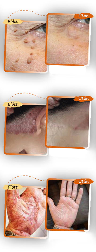 ✅ Pureluxo® Fekete Rizses Bőrregeneráló Krém 👨‍⚕️ (Szemölcsök, bőrkinövések, foltok és hiperpigmentáció kezelésére)✅✅