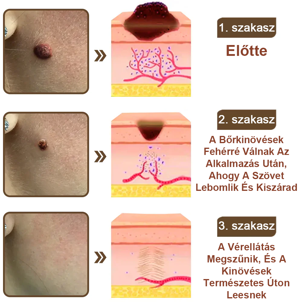✅ Pureluxo® Fekete Rizses Bőrregeneráló Krém 👨‍⚕️ (Szemölcsök, bőrkinövések, foltok és hiperpigmentáció kezelésére)✅✅