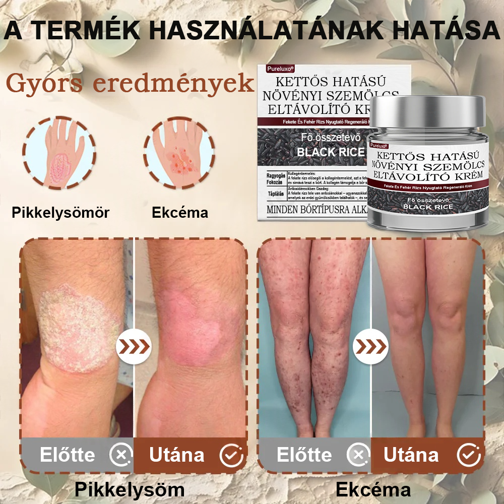 ✅ Pureluxo® Fekete Rizses Bőrregeneráló Krém 👨‍⚕️ (Szemölcsök, bőrkinövések, foltok és hiperpigmentáció kezelésére)✅✅